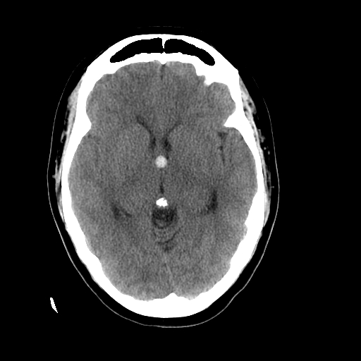 <p>Head&nbsp;CT,&nbsp;Colloid Cyst at the Foramen of Monro</p>