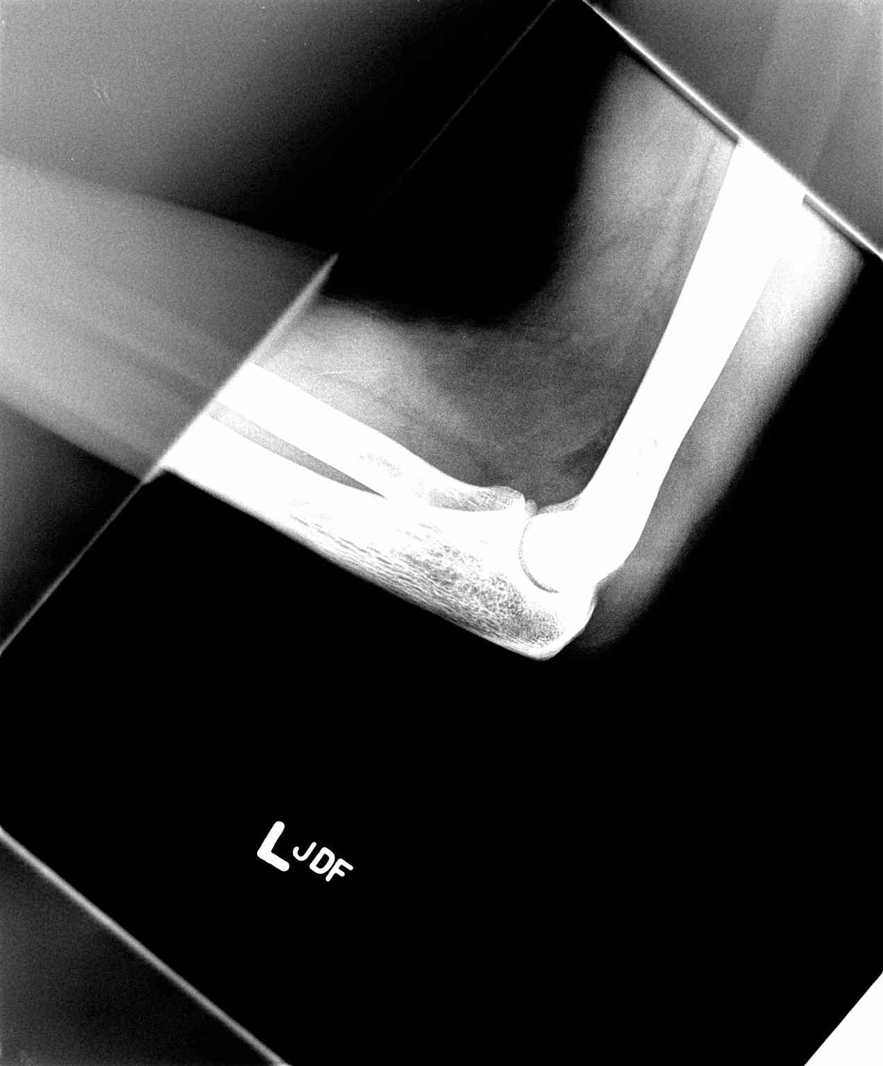 <p>Occult Olecranon Fracture on Lateral Elbow Radiograph