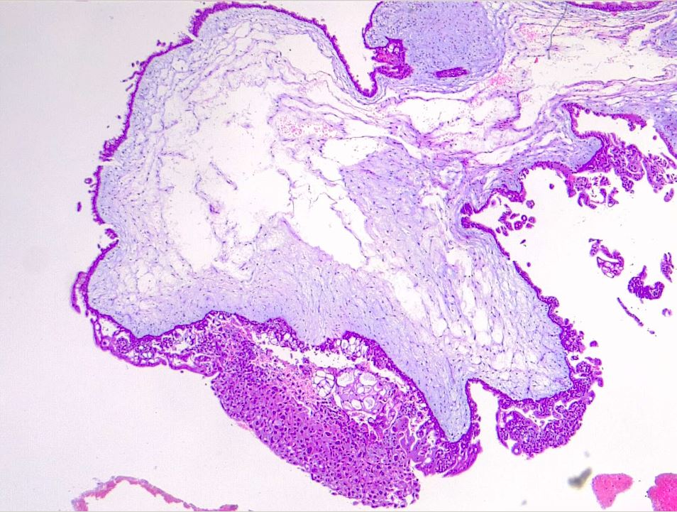 <p>Hydropic Villi and Trophoblastic Proliferation. Hydatiform mole, H/E 4x.</p>