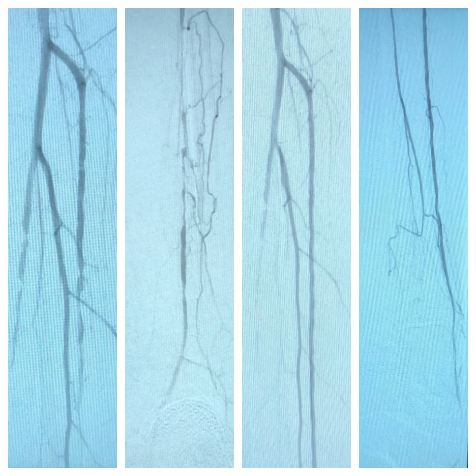 Peripheral Arterial Disease - Occluded anterior tibial artery