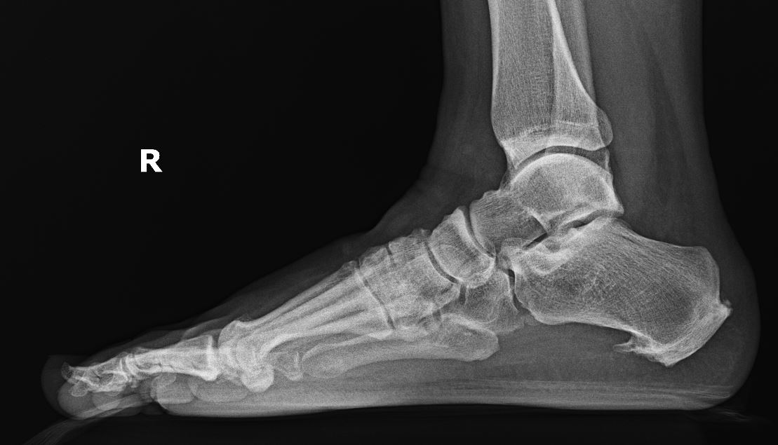 <p>Plantar Calcaneal Spur