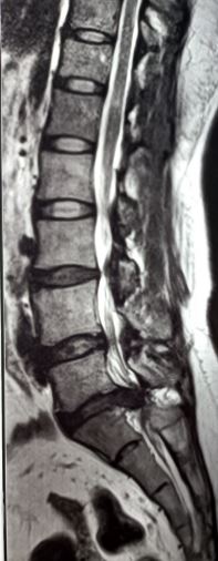 <p>Cauda Equina Syndrome