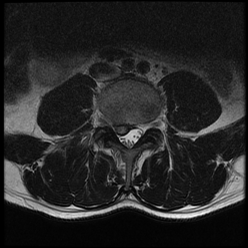 <p>Lumbar Spine Disc Herniation, Magnetic Resonance Image