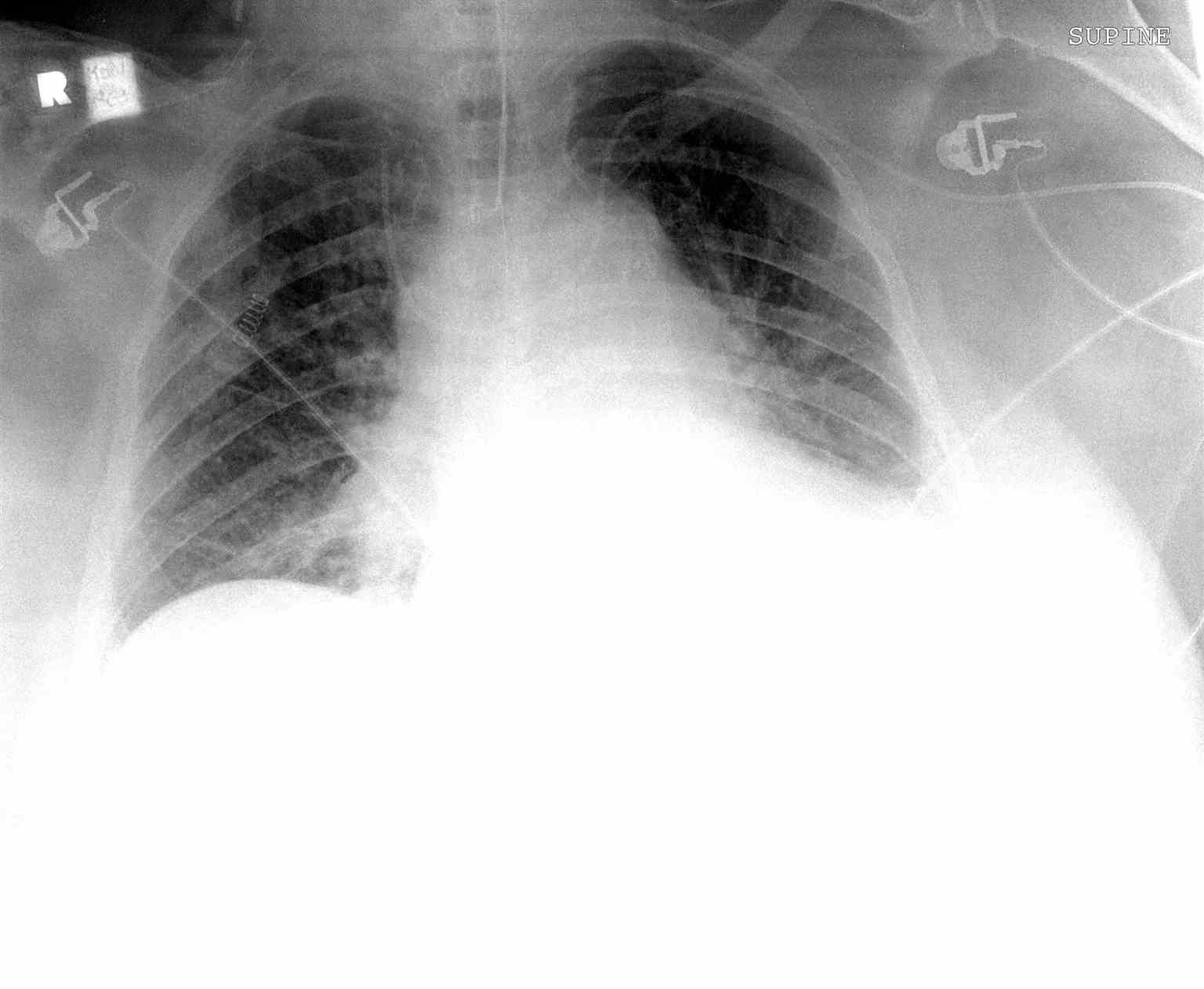 <p>Chest Radiograph, Malpositioned Central Line</p>