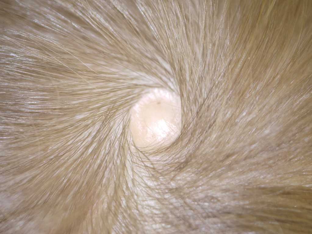 <p>Scalp Defect in Aplasia Cutis Congenita