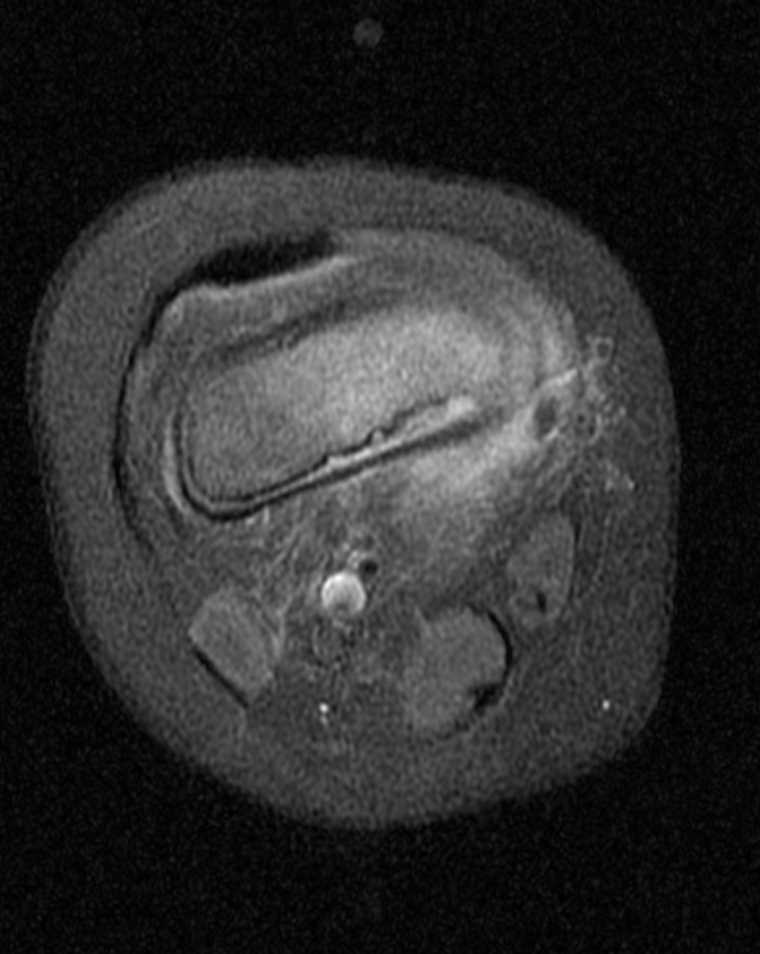 <p>MRI T1-Weighted Postcontrast, Knee Osteomyelitis</p>