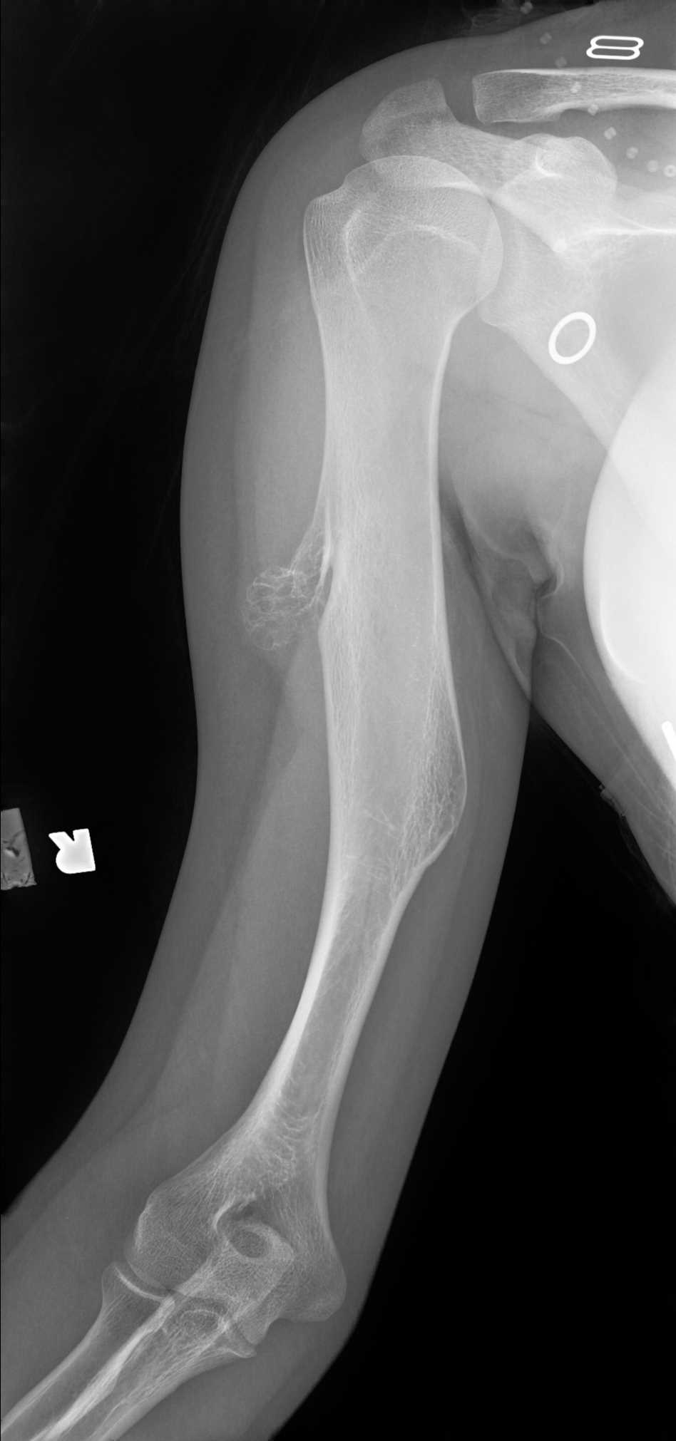 <p>Humerus Radiograph, Osteochondroma</p>