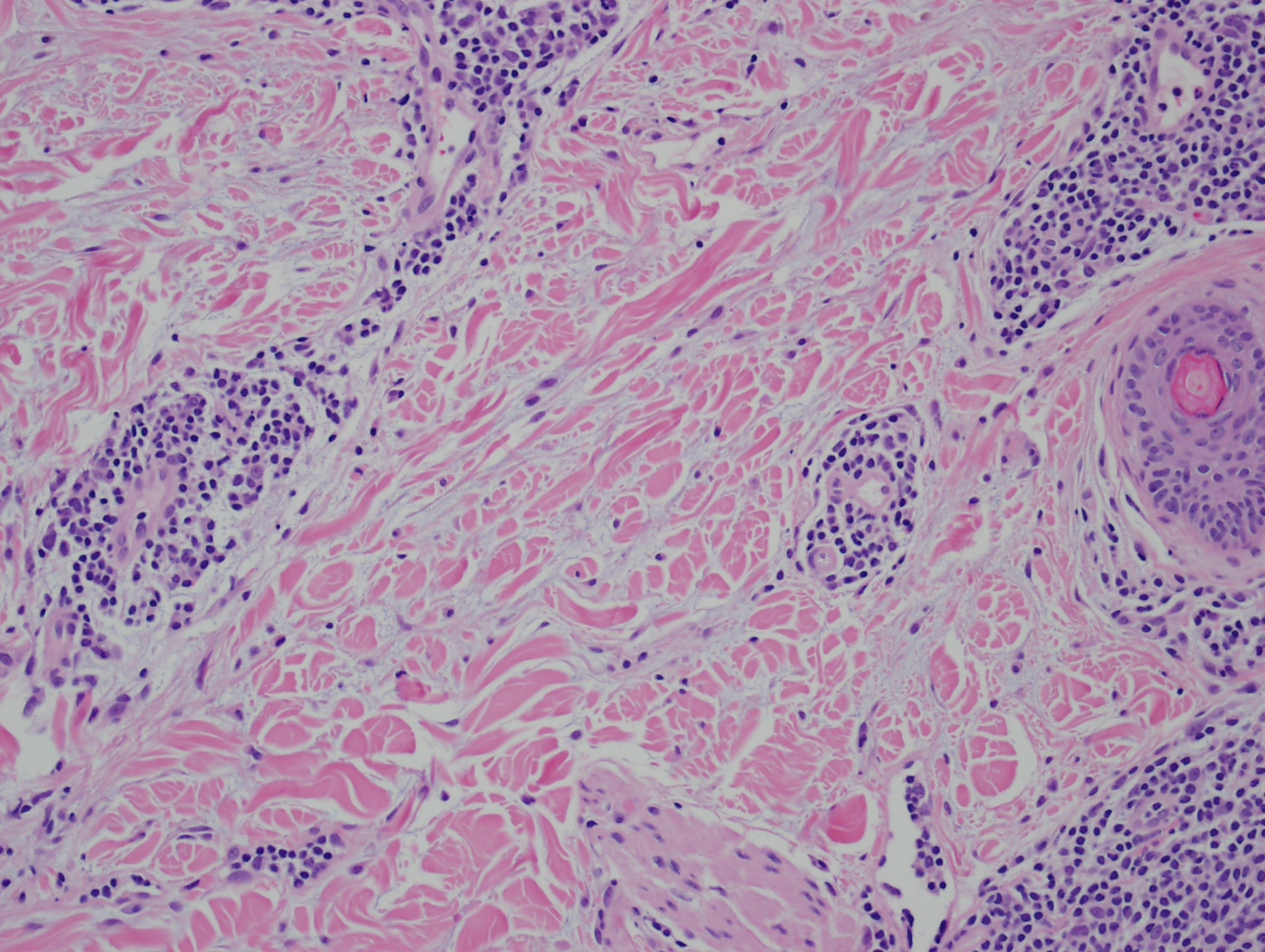 20X histopathology tumid lupus erythematosus