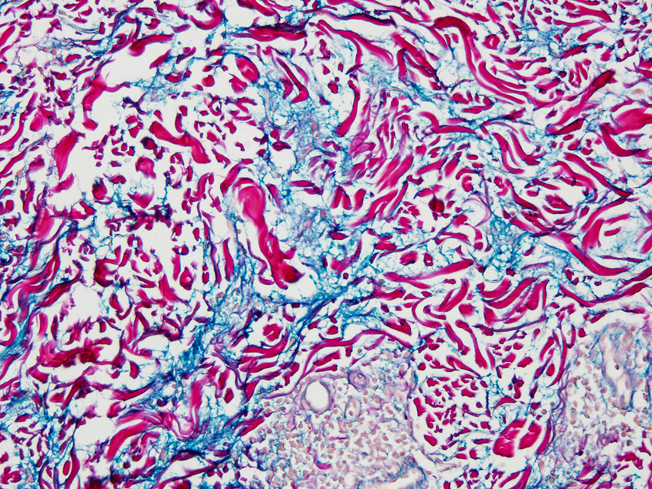 Increased interstitial dermal mucin tumid lupus