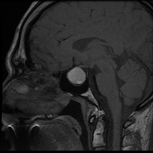 <p>T1-Weighted Magnetic Resonance Imaging of Pituitary Apoplexy