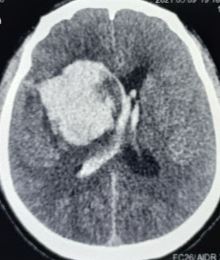 <p>Intracranial Hemorrhage in the Caudate Region