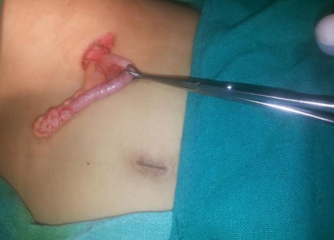 Appendectomy