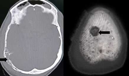 Bone metastasis from breast cancer