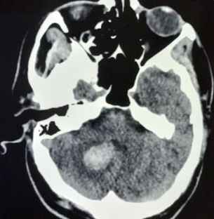 Cerebellar hematoma