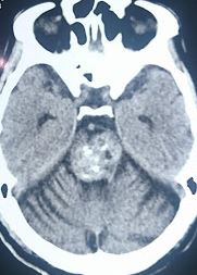 Brainstem cavernoma