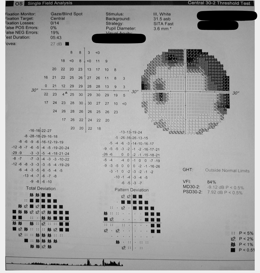 <p>Left Eye Glaucomatous Visual Field Changes