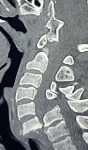 <p>Traumatic Cervical Spondyloptosis of the C6-C7 Segments.</p>