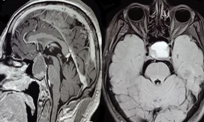 <p>Magnetic Resonance Imaging of Pituitary Apoplexy. The image displays MRI scans illustrating pituitary apoplexy.</p>