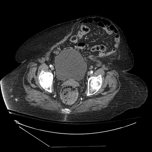 <p>Abdomen CT,&nbsp;Ventral Hernia</p>