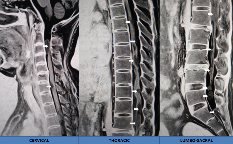 Holospinal drop metastasis