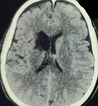 Stroke in the territory of recurrent artery of Heubner