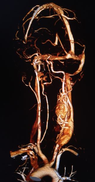 Carotid body tumor