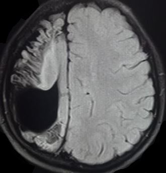 <p>Seizure From Cortical Changes and Porencephalic Cyst