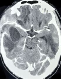 <p>Temporal Lobe Abscess.</p>