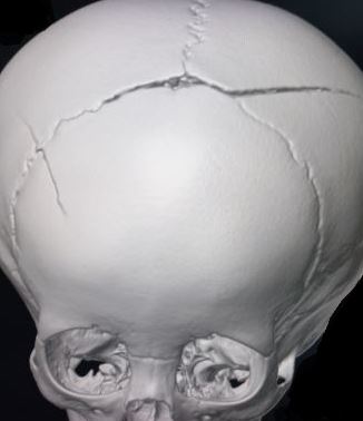 <p>Fracture Traversing the Superior Sagittal&nbsp;Sinus</p>