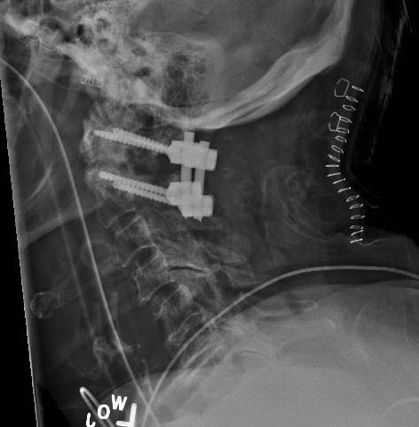 Transvaginal ultrasound sagittal image of a fibroid uterus