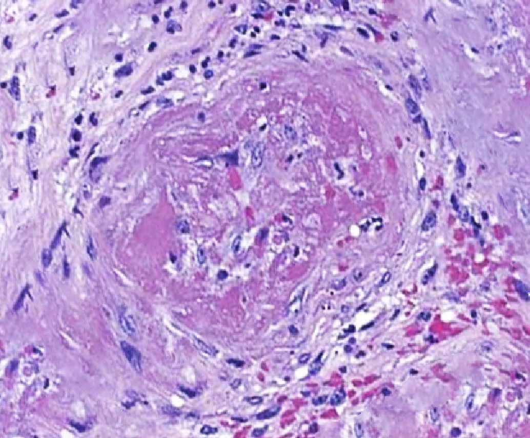 <p>Histopathological Changes in Microscopic Polyangiitis Showing Fibrosis.</p>