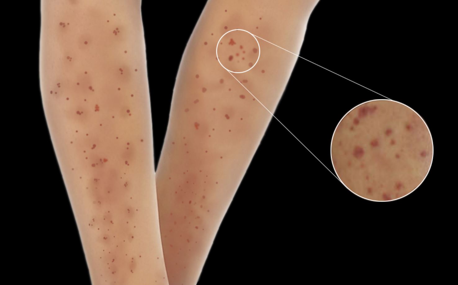 <p>Typical Skin Manifestations Observed in Microscopic Polyangiitis.</p>