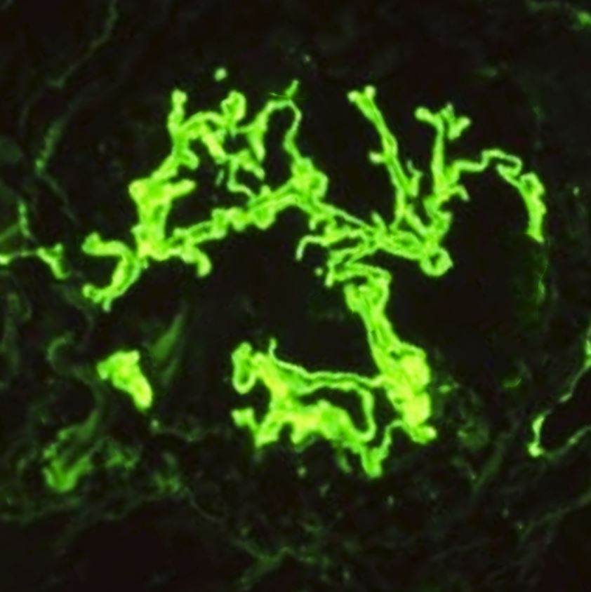 <p>Immunofluorescence Staining for IgG. The image shows&nbsp;linear staining of the glomerular basement membrane.</p>