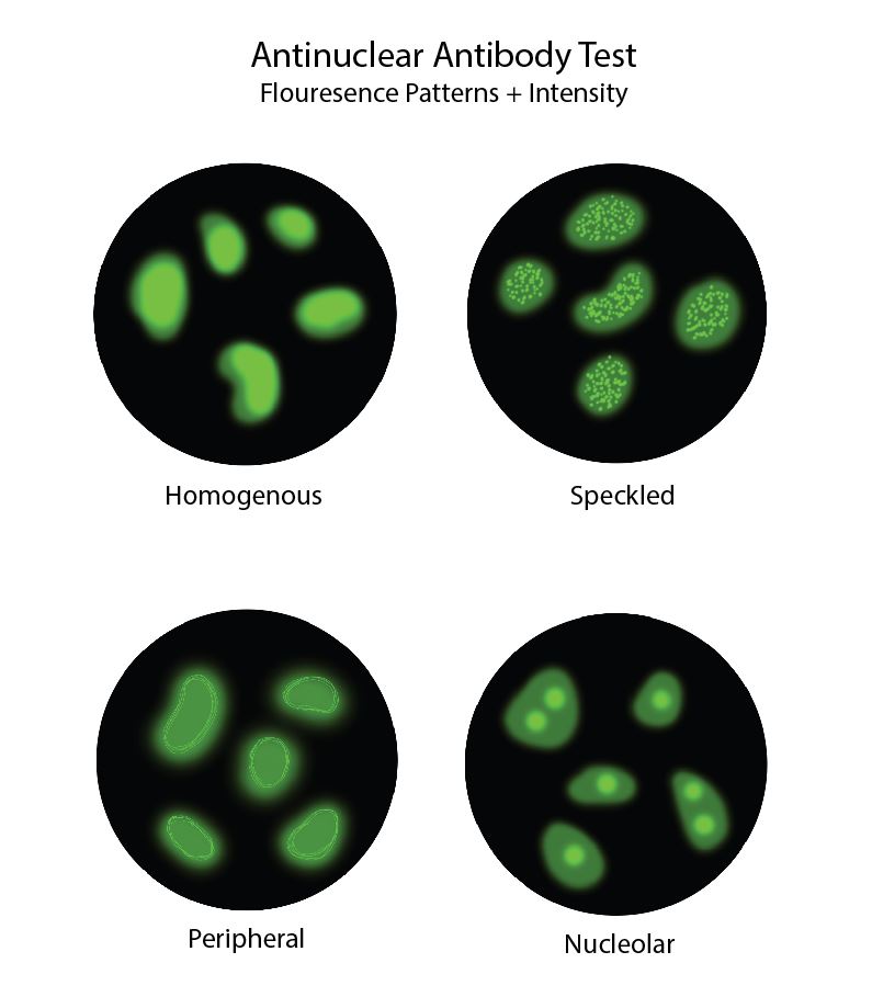 <p>Antinuclear Antibody Fluorescence Patterns Diagram</p>