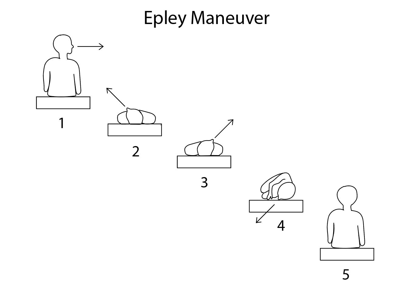 <p>Epley Maneuver. This diagram shows the steps of the Epley maneuver.</p>