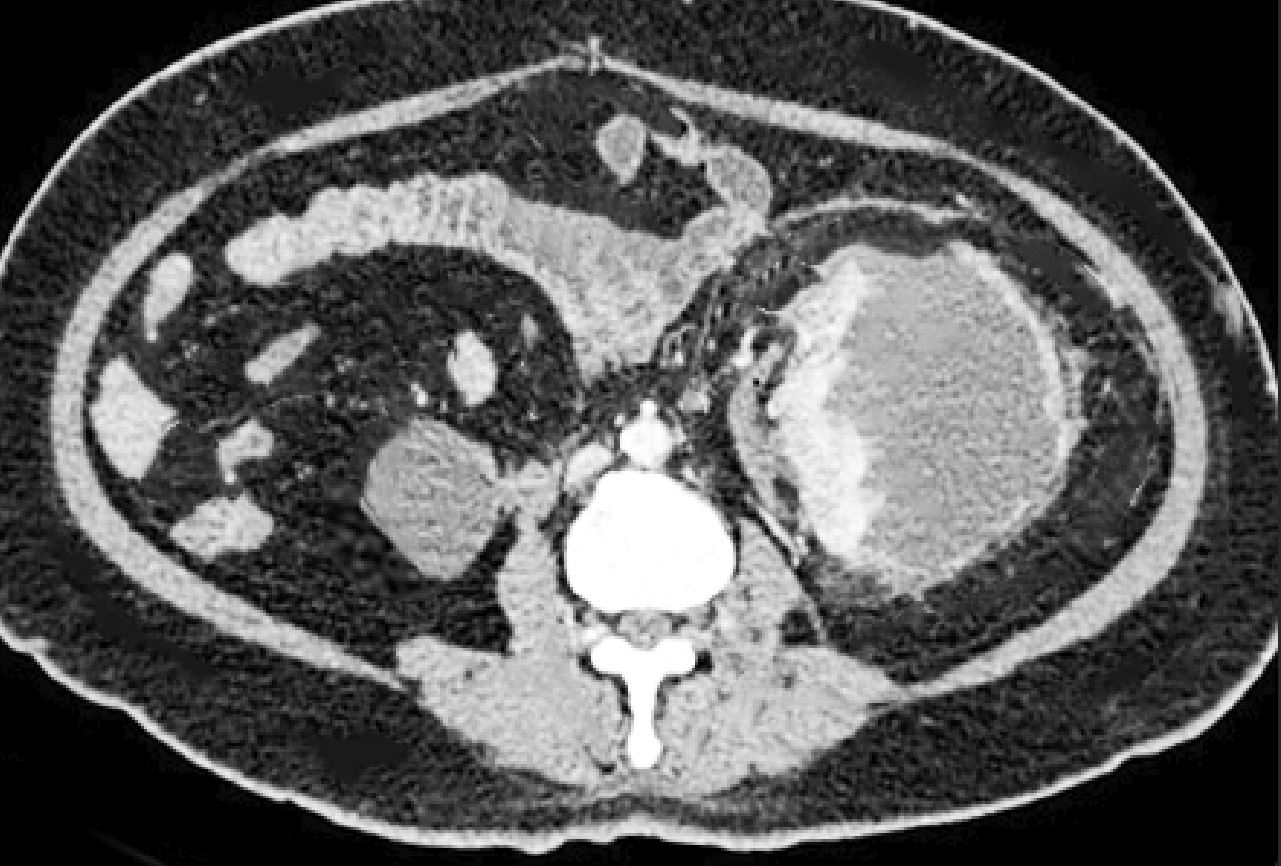 <p>Page Kidney, Computed Tomography Scan. This image portrays a Page kidney on a computed tomography scan.</p>