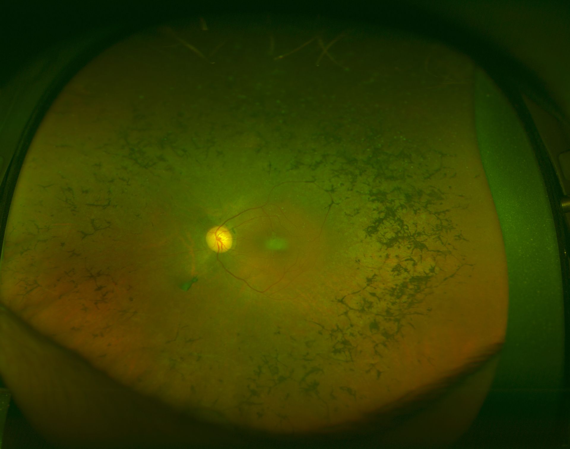 <p>Retinitis Pigmentosa: The fundus appearance of RP classically includes a triad of retinal vessel attenuation, waxy pallor of the optic disc, and bone spicule intraretinal pigmentation