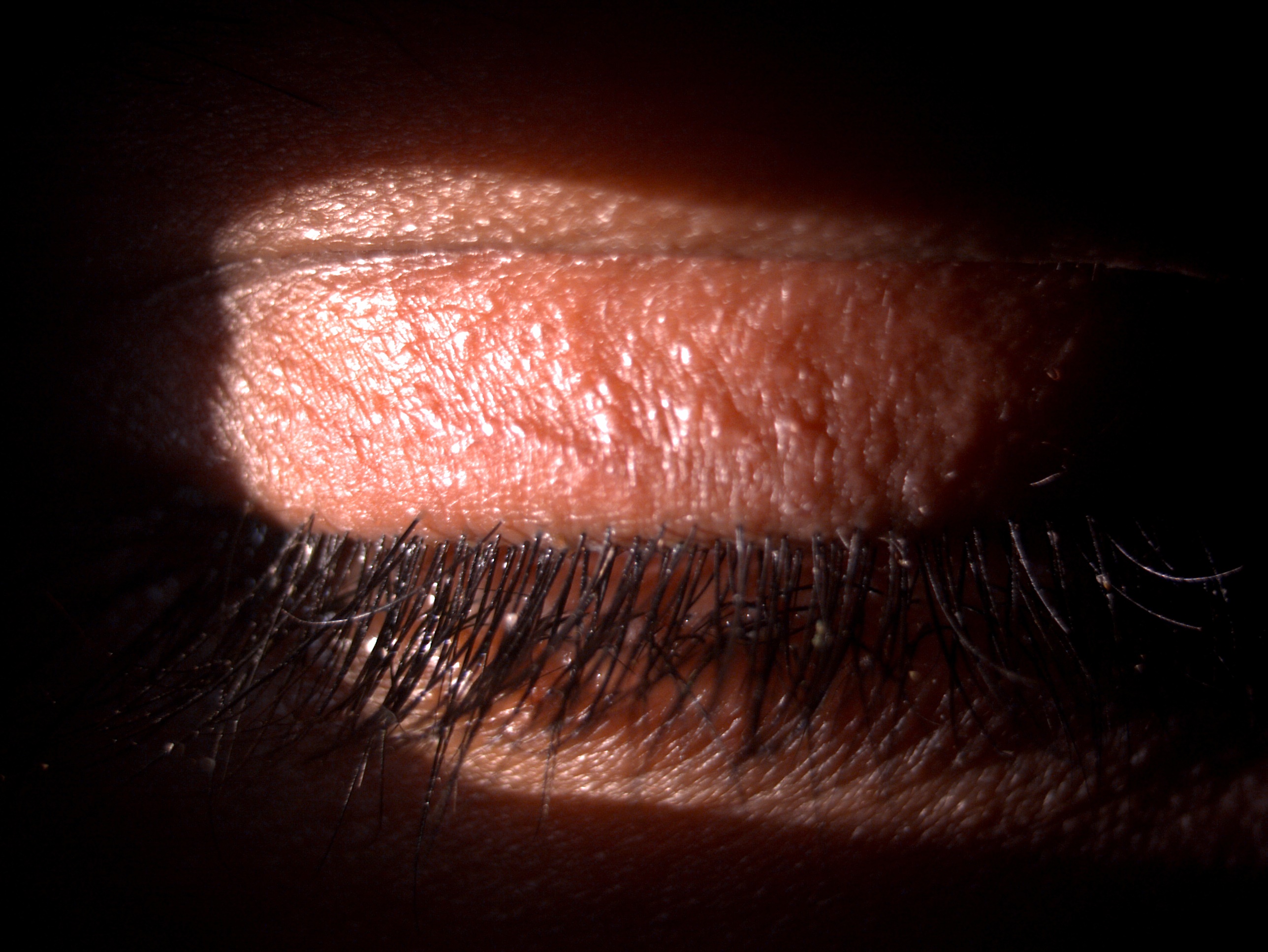 <p>Phthiriasis Palpebrarum with Seborrheic Anterior Blepharitis