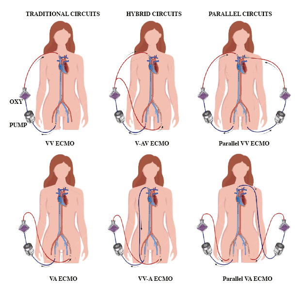 <p>Types of ECMO Circuits