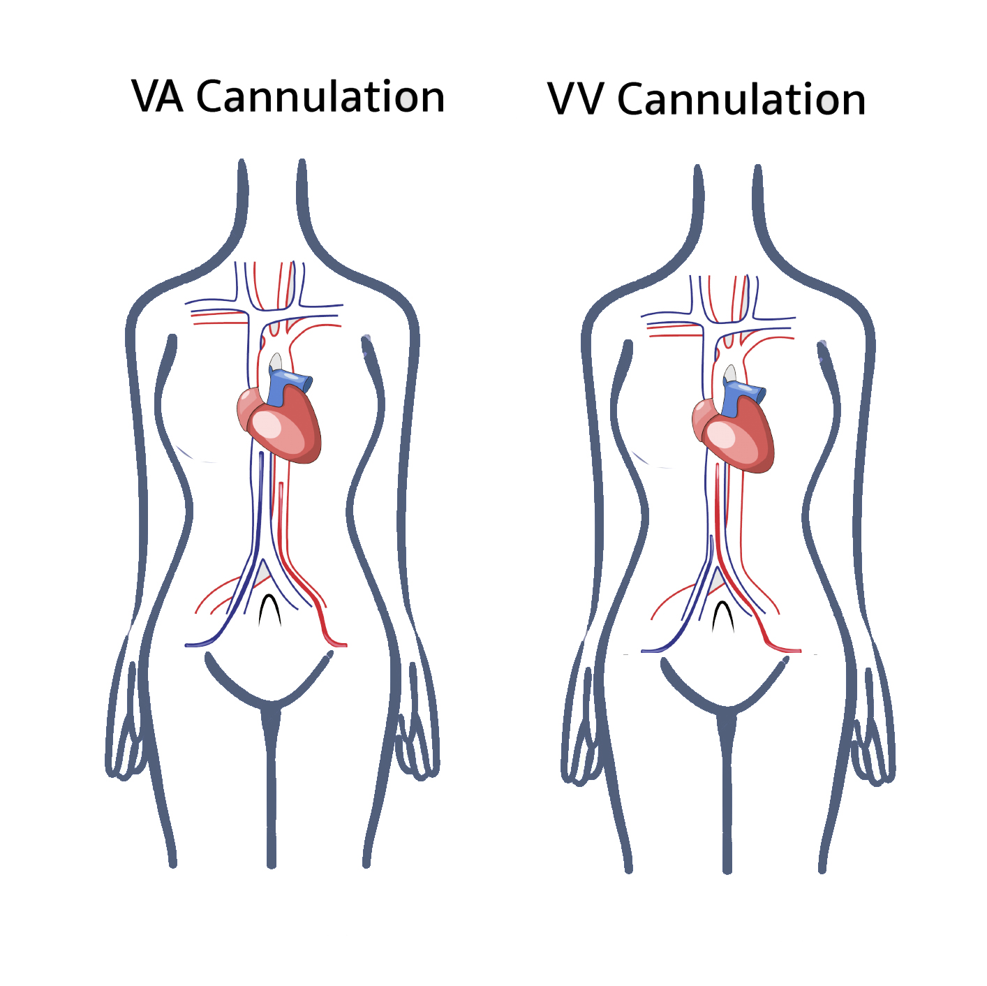 <p>Traditional VA and VV ECMO Cannulation