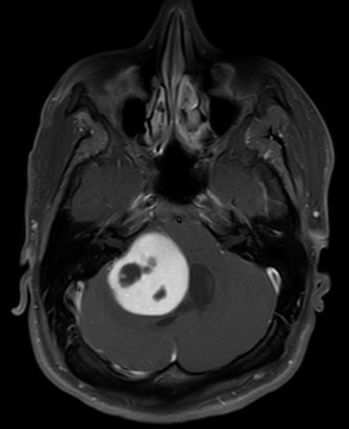 <p>MRI of the Brain Showing Pilocytic Astrocytoma.</p>