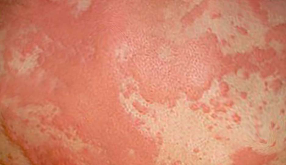 <p>Anaphylaxis, Hives. This image depicts hives due to anaphylaxis on the skin.</p>