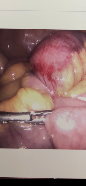 <p>Closed-Loop Bowel Obstruction due to Adhesion</p>