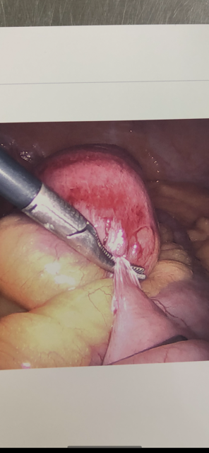 <p>Closed-Loop Bowel Obstruction</p>