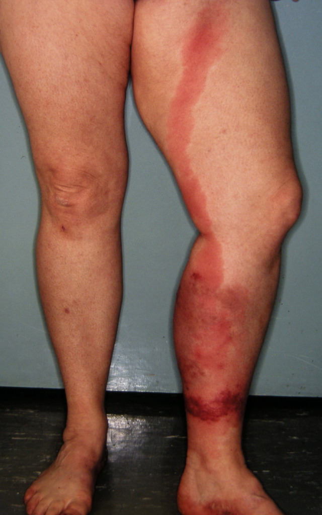 <p>Cellulitis</p>