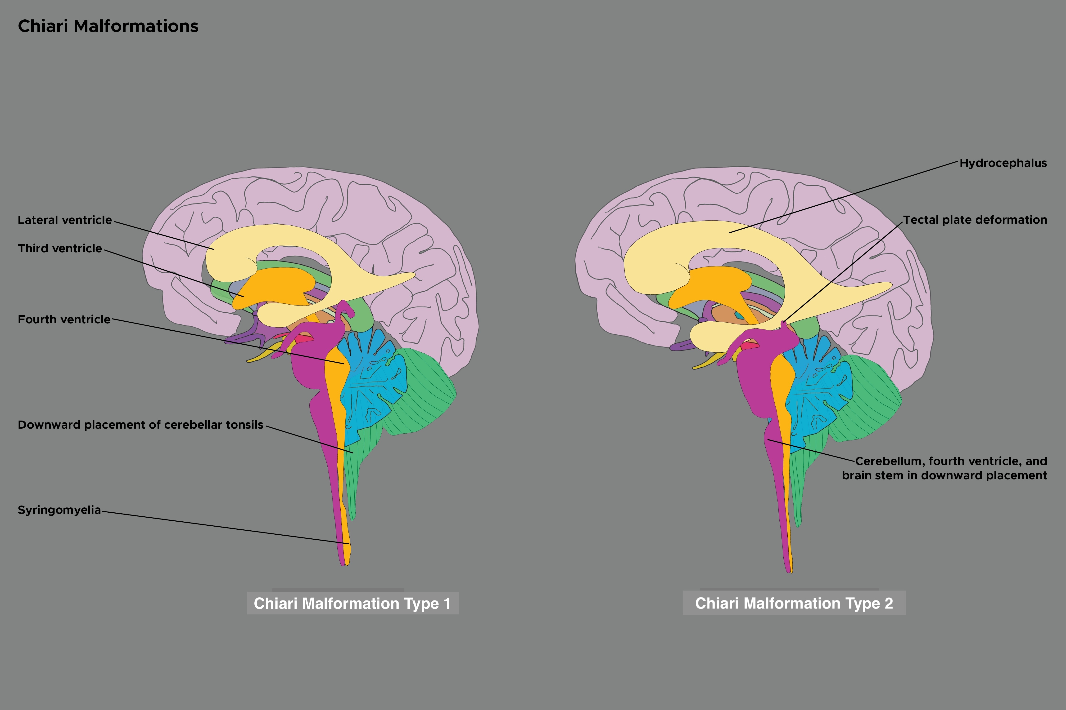 <p>Chiari Malformation Types 1 and 2</p>