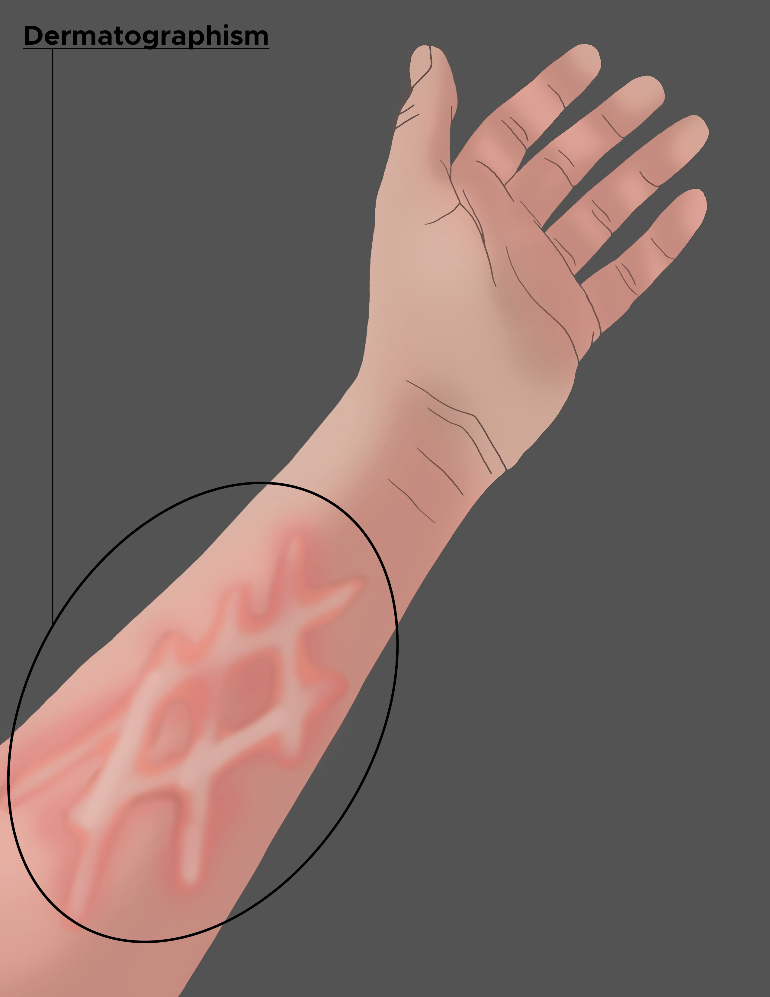 <p>Dermatographism. The illustration of the forearm displays dermatographism on the skin.</p>