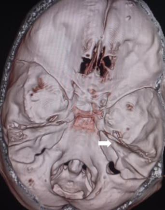 <p>The Petrous Part of the Temporal Bone