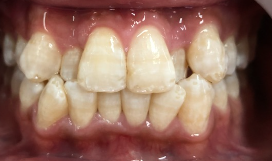 Dental Fluorosis