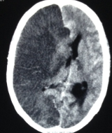 Hemispheric infarction